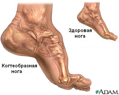 когтеобразная нога, болезнь шарко-мари-тута