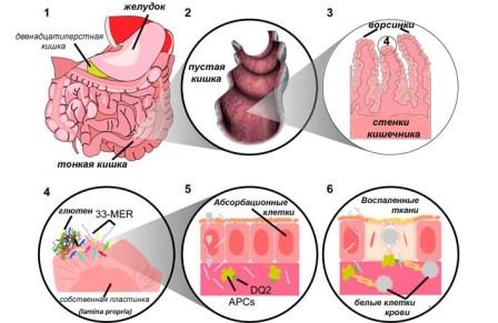 целиакия, тонкая кишка, желудок, ворсинки