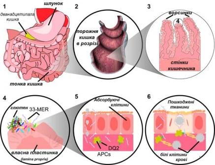 целіакія, тонка кишка, шлунок, ворсинки