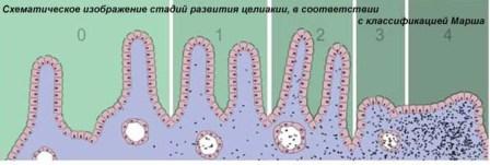 классификация Марша, целиакия