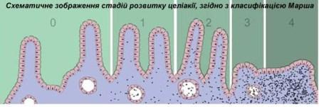 класифікація Марша, целіакія