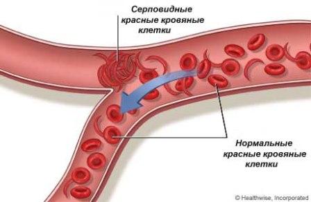 серповидные эритроцити, генетика, хромосома, анемия