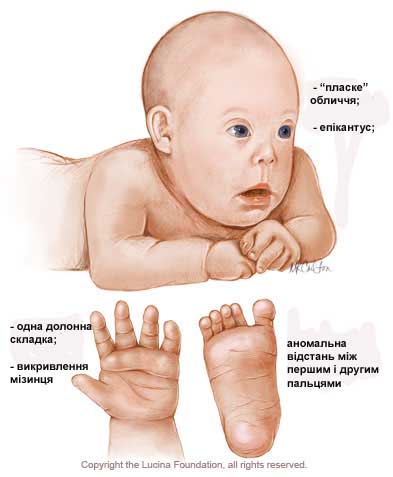 синдром дауна, генетика, 21 хромосома, гени