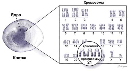 синдром дауна, трисомия 21