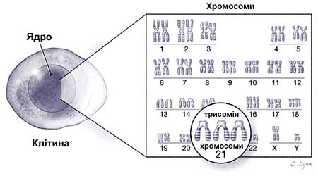 трисомія 21, хромосома, синдром дауна