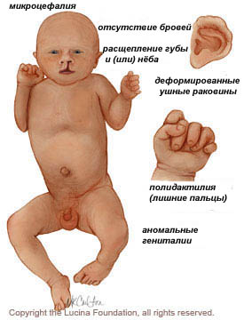 синдром Патау, лишние пальцы, микроцефалия