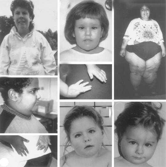 синдром Прадера-Вилли, косоглазие, ожирение, 15 хромосома
